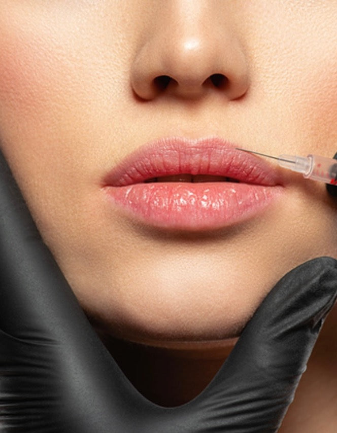 Natural lip enhancement and Russian lip newcastle | lip filler Gosforth | lip filler Ponteland