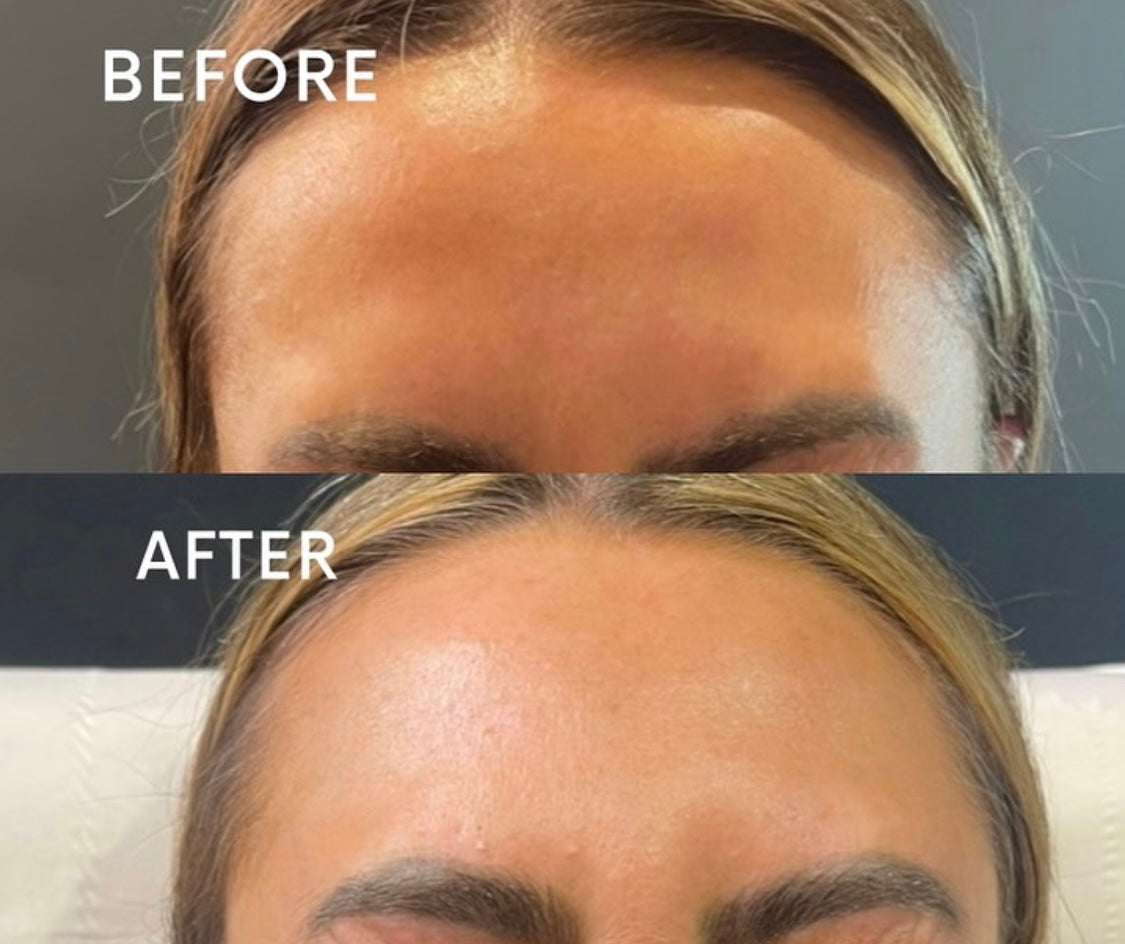 Botox Allergan - Jawline & Nefertiti