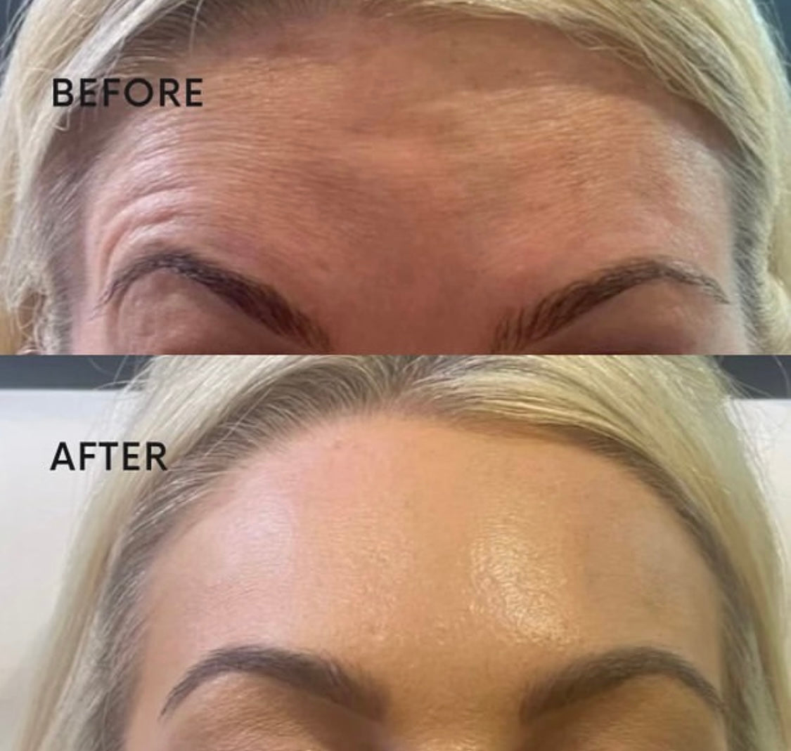 Botox Gosforth Newcastle by advanced aesthetics at Beauty At Gosforth Park