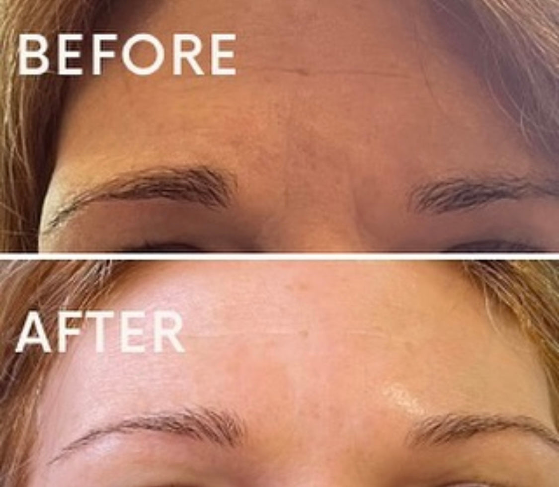 Botox Gosforth, Newcastle Upon Tyne.  Based at Beauty At Gosforth Park, Gosforth, Newcastle