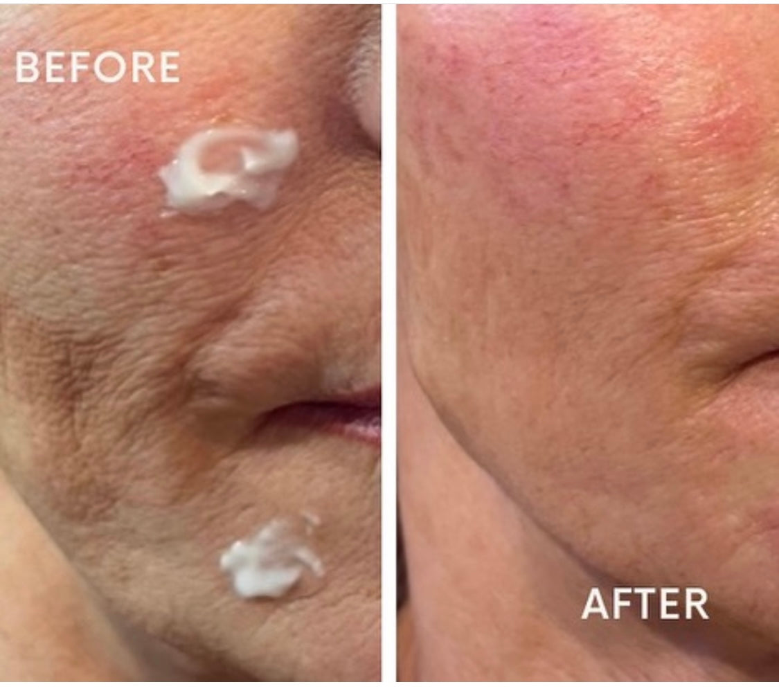 Profhilo with Advanced Aesthetics Practitioner Beauty At Gosforth, Gosforth, Newcastle Upon Tyne