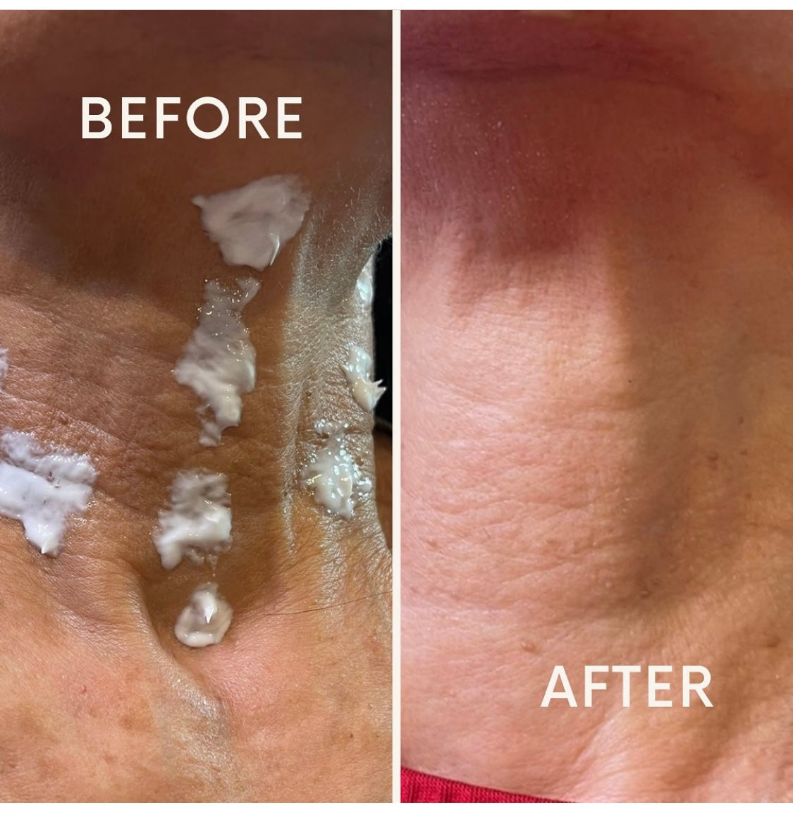 Profhilo by Kate Advanced Aesthetics Practitioner at Beauty At Gosforth Park, Gosforth, Newcastle upon tyne