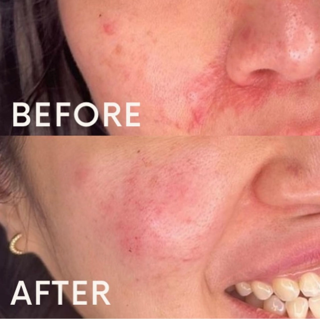 Seventy hyal skin booster results for rosacea. Book a consultation with Kate at Beauty At Gosforth Park