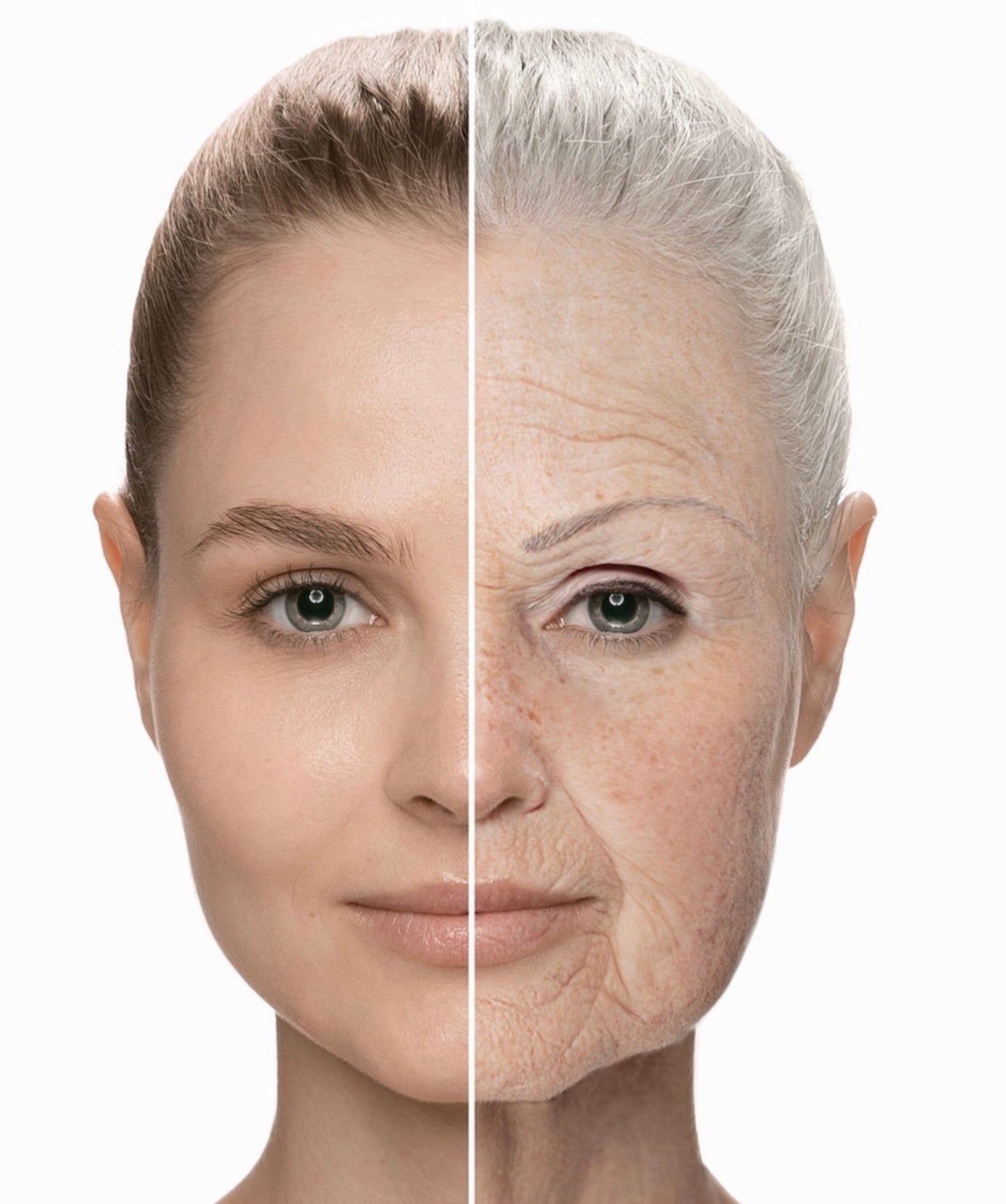 Profhilo Newcastle Upon tyne | Profhilo Gosforth | Profhilo Ponteland