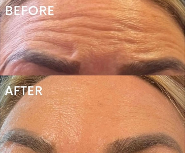 Botox - Newcastle Upon Tyne – Kate Walton Skin