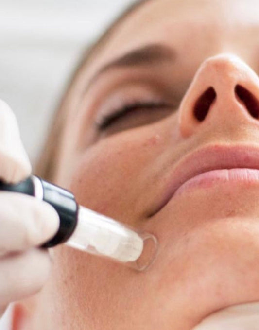 Microneedling face, neck and chest newcastle.  Microneedling Ponteland.  Microneedling Gosforth 