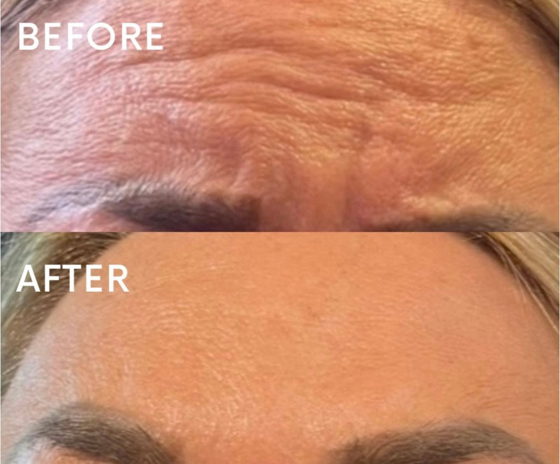 Botox Allergan - 3 Areas