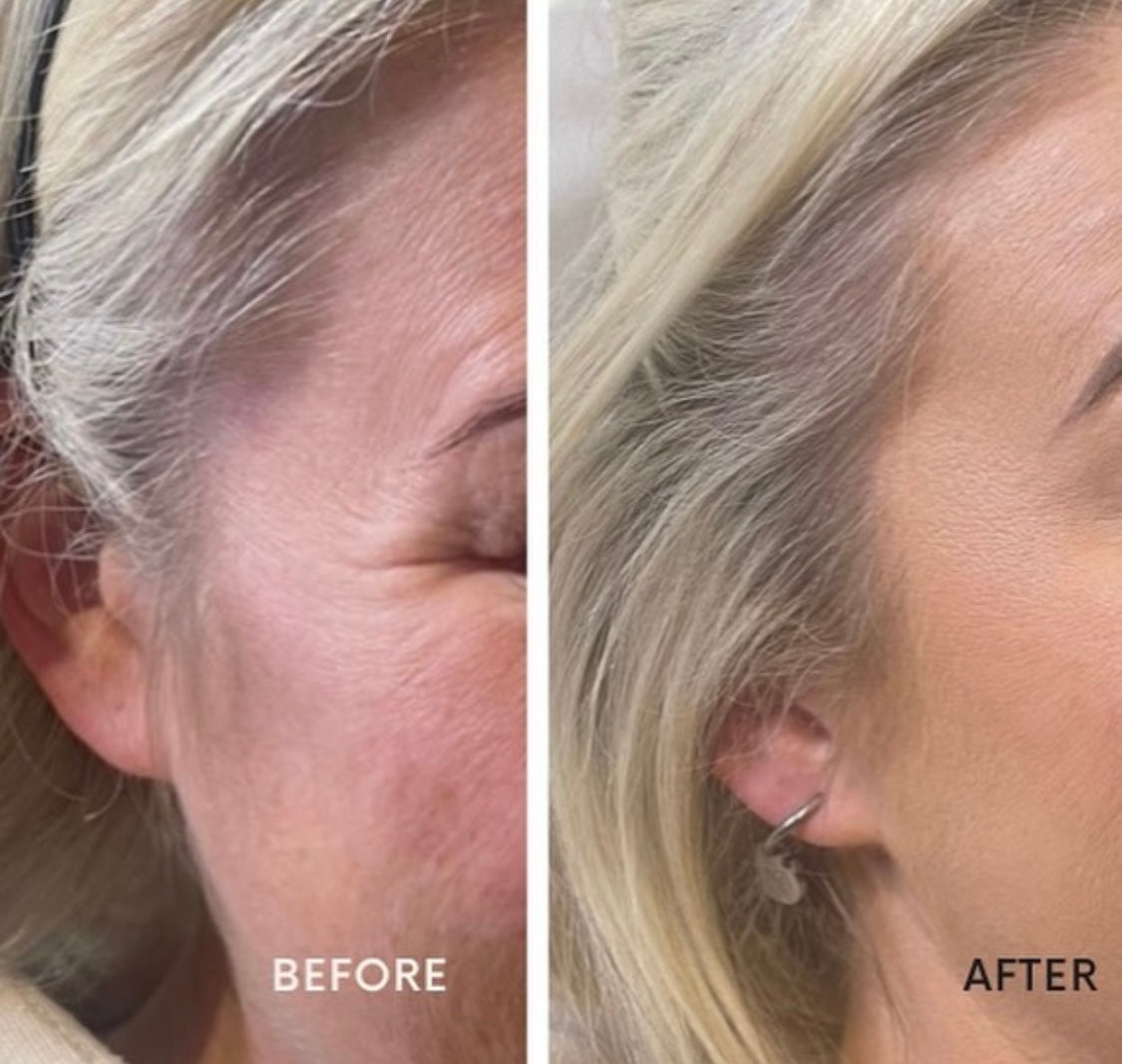 Botox by advanced aesthetics Practitioner Kate at Beauty At Gosforth Park, Newcastle Upon Tyne