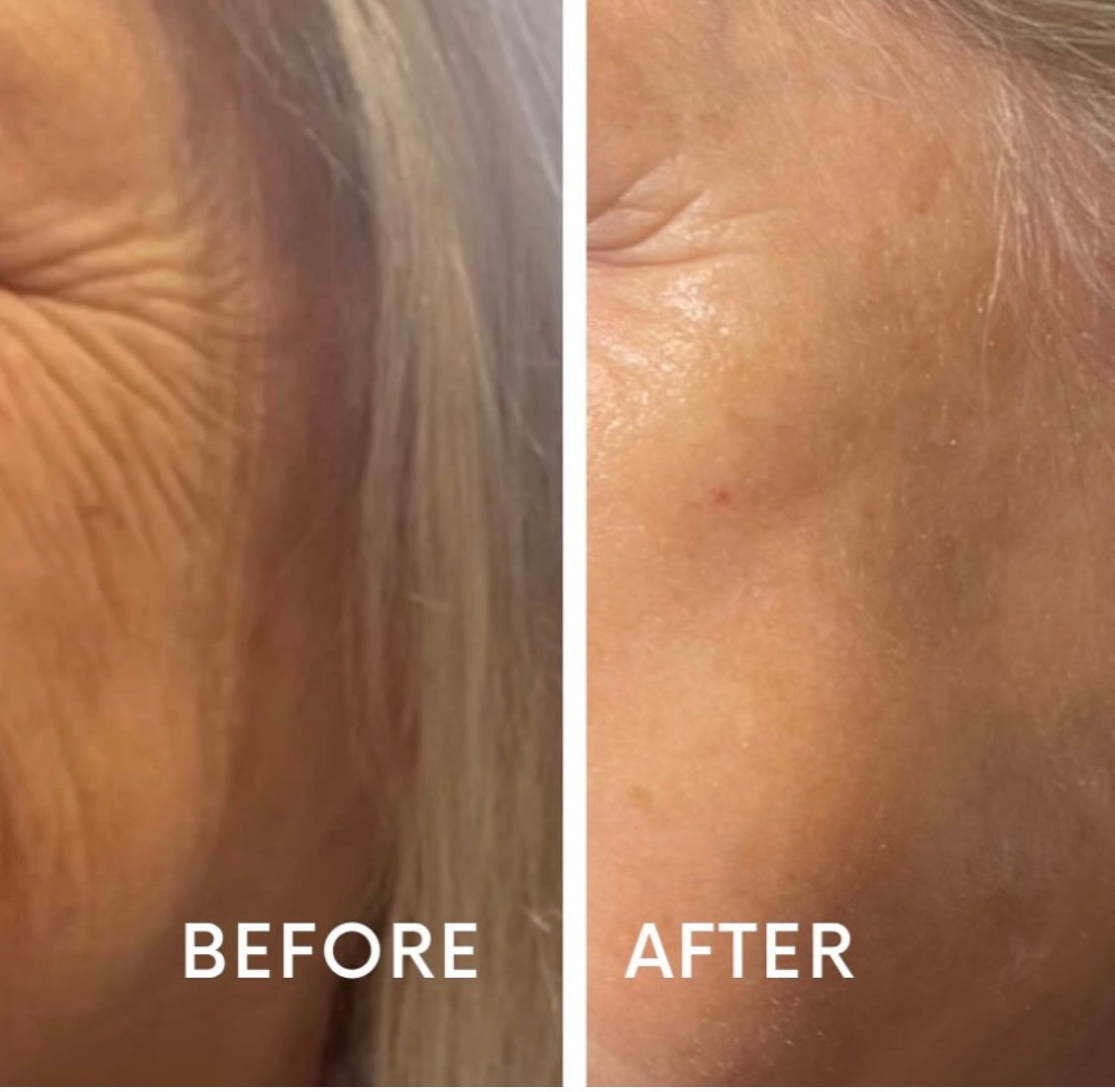 Profhilo by advanced aesthetics practitioner at Beauty At Gosforth Park, Gosforth, Newcastle 