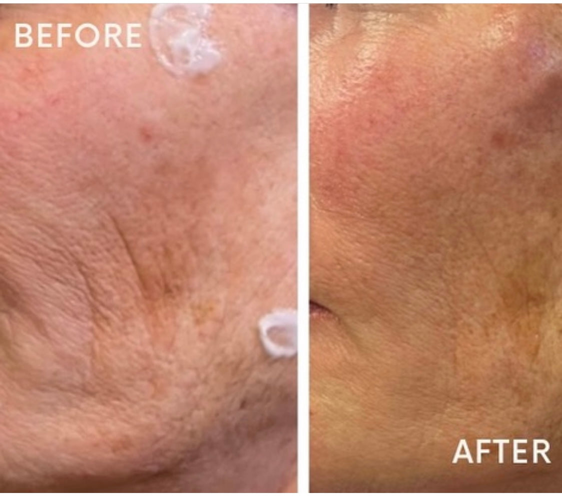 Profhilo by Advanced Aesthetics Practitioner at Beauty At Gosforth Park, Gosforth, Newcastle Upon Tyne