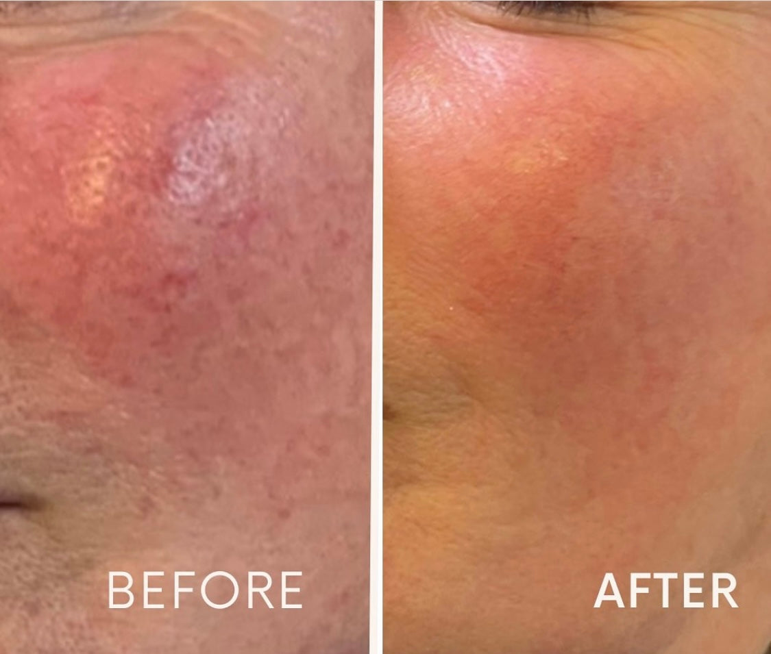 Advanced Aesthetics Practitioner at Beauty At Gosforth, Gosforth Newcastle Upon Tyne