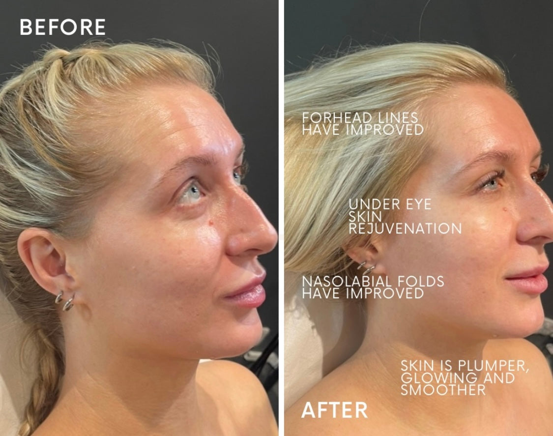 X3 Micro-needling with Polynucleotides