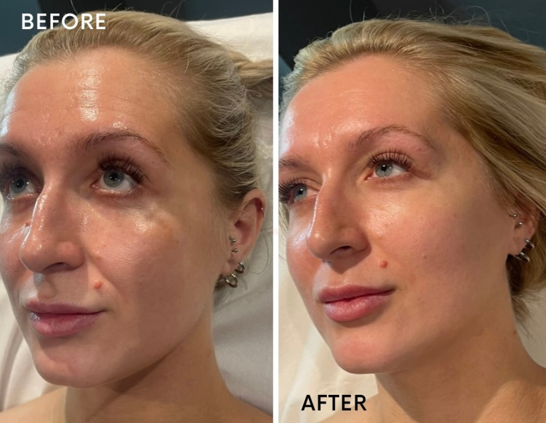 X3 Micro-needling with Polynucleotides