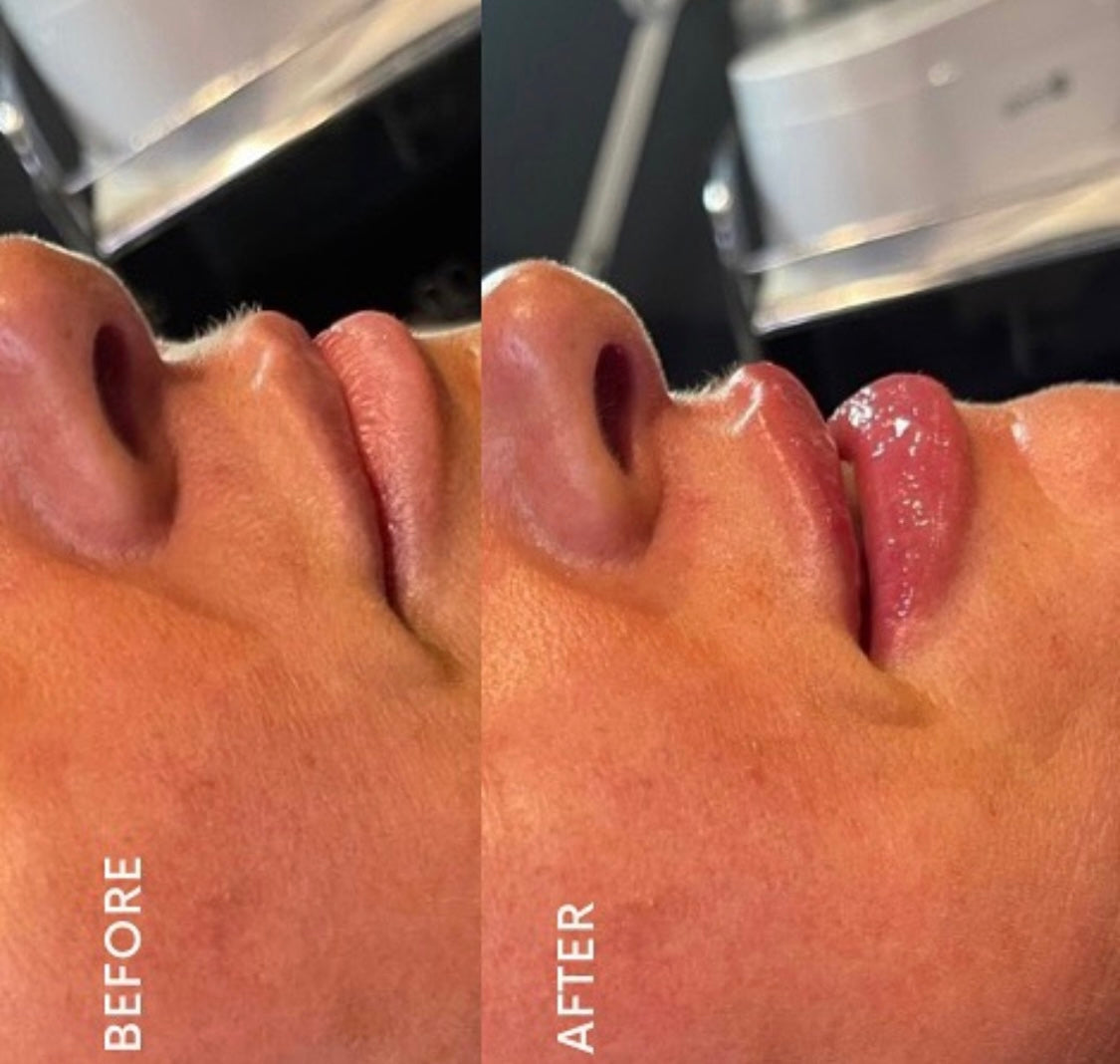 Lip filler and natural lip enhancement by Kate Advanced aesthetics practitioner at Beauty At Gosforth Park, Newcastle 
