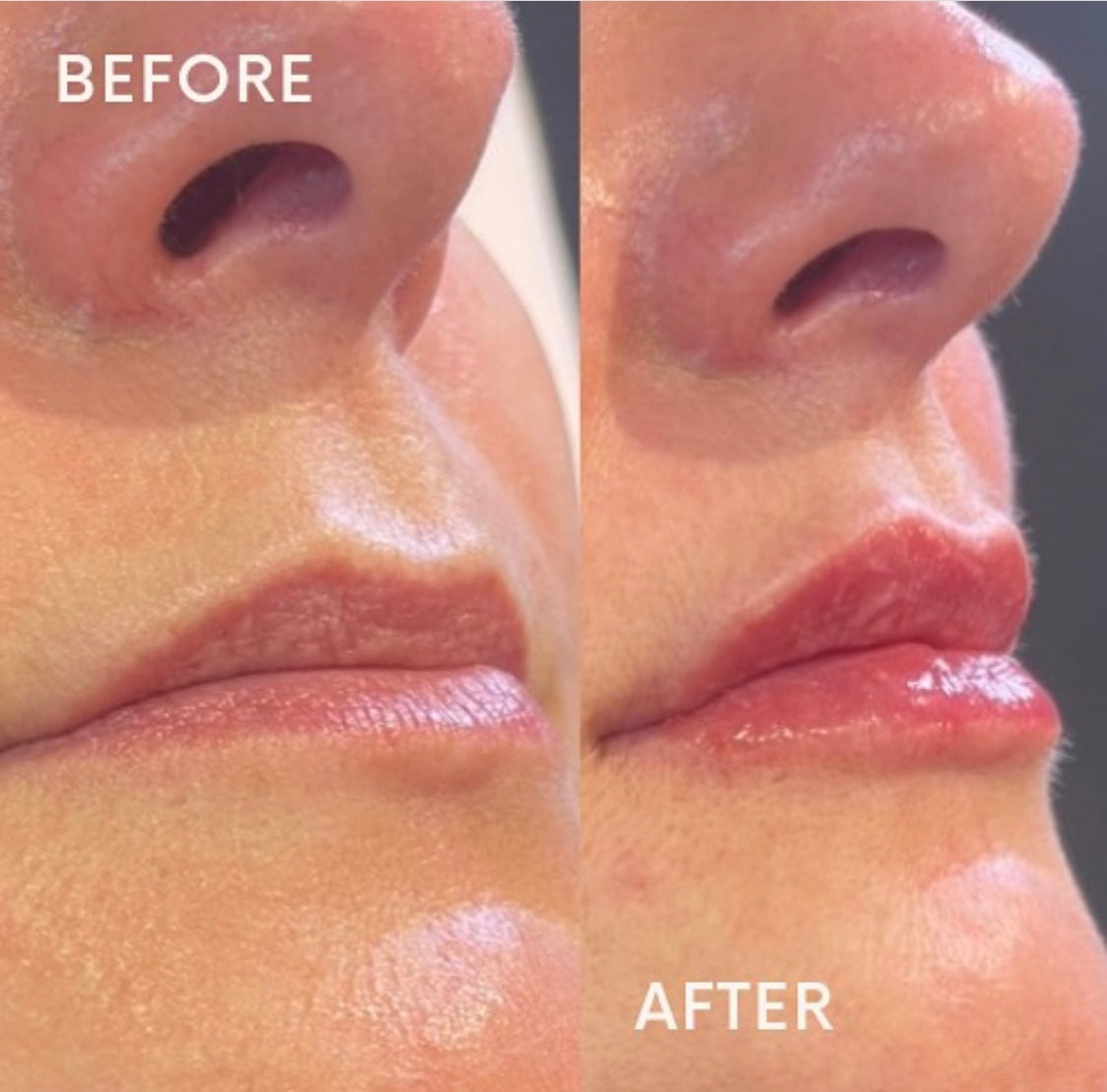 Natural lip enhancement by Advanced Aesthetics Practitioner Kate at Beauty At Gosforth Park, Newcastle Upon Tyne