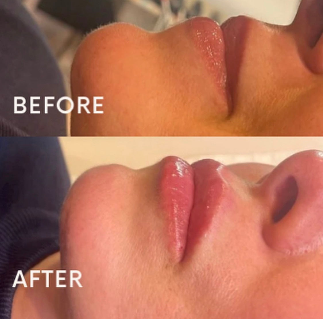 Lip fillers - 1.1ml