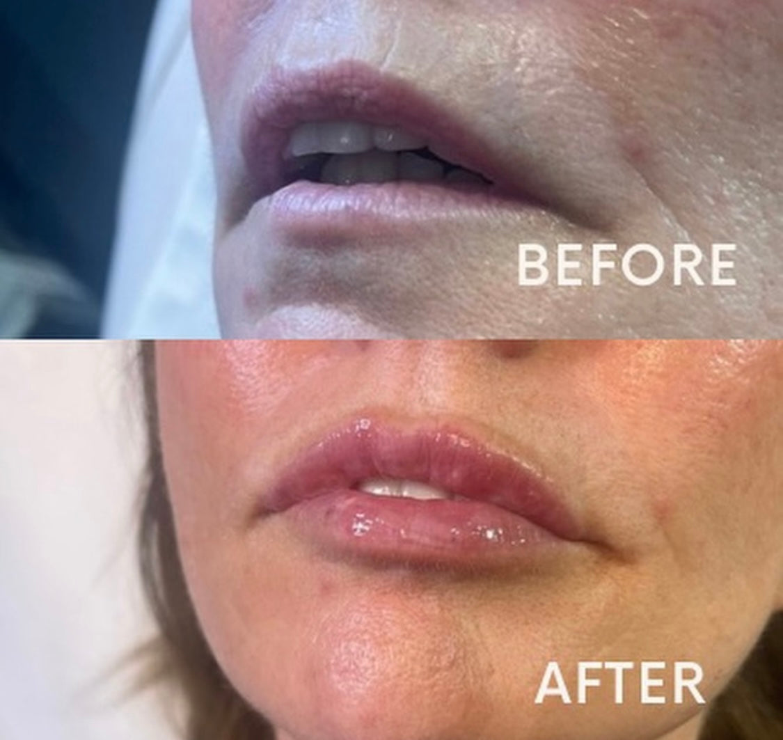 Natural Lip filler for smokers lines by Advanced Aesthetics Practitioner at Beauty At Gosforth Park, Newcastle 