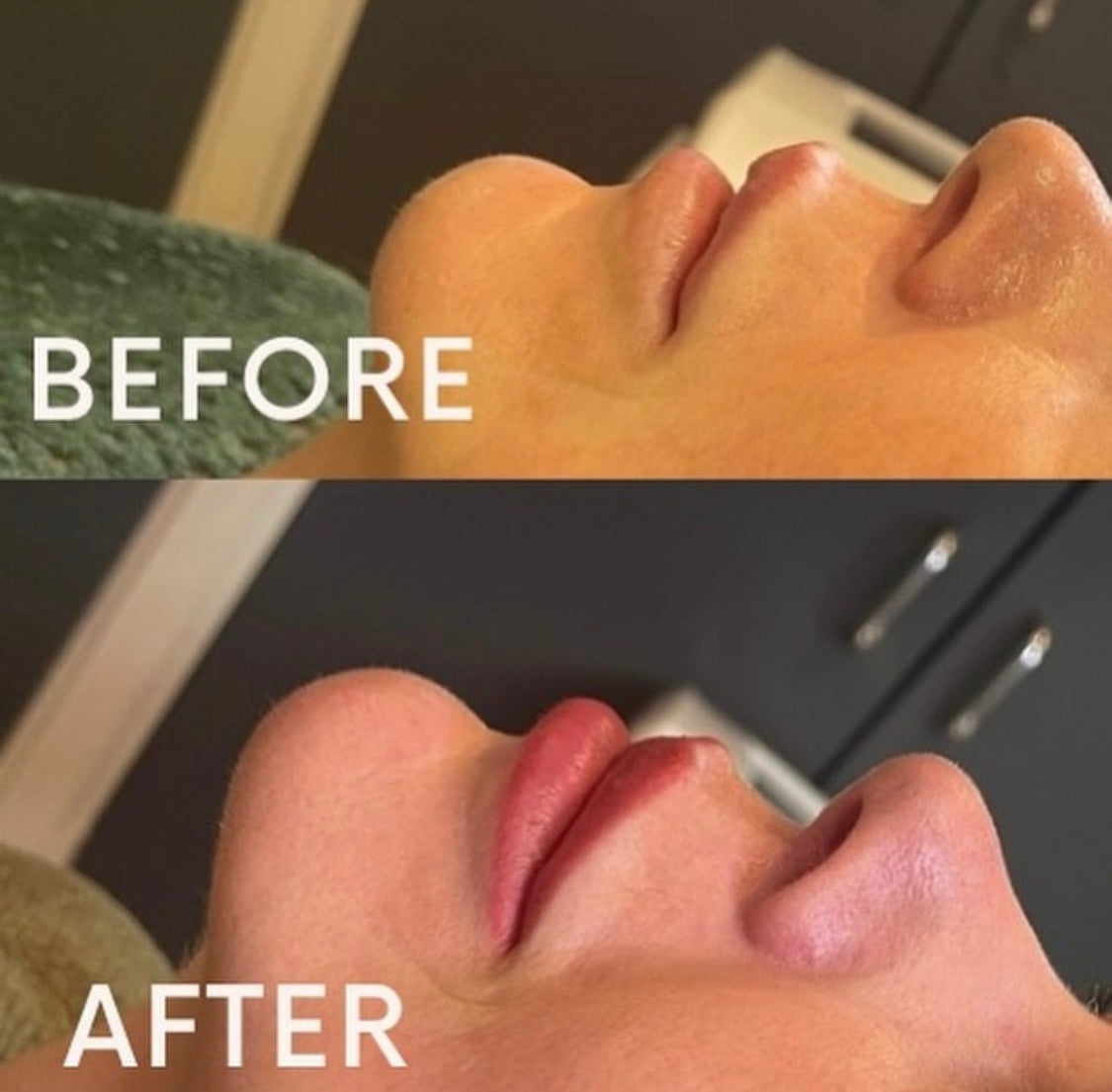 Lip fillers - 1.1ml