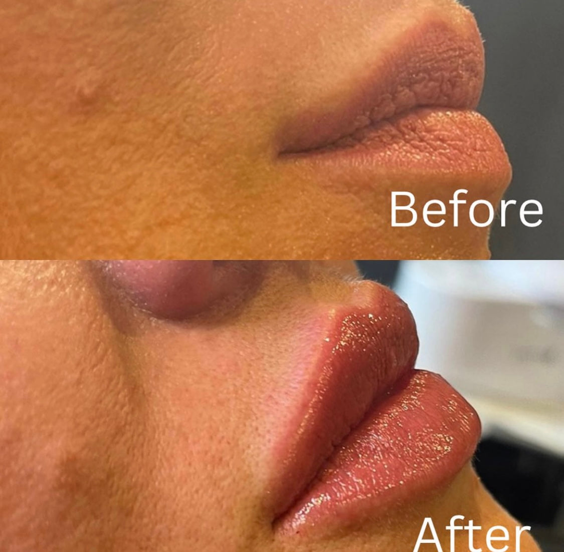 Natural Lip Filler, Gosforth, Newcastle Upon Tyne by Advanced Aesthetics Practitioner Kate at Beauty At Gosforth Park