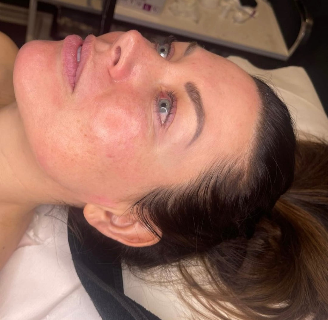 Micro-needling - Aesthetics Newcastle, Gosforth, Newcastle Upon Tyne ...